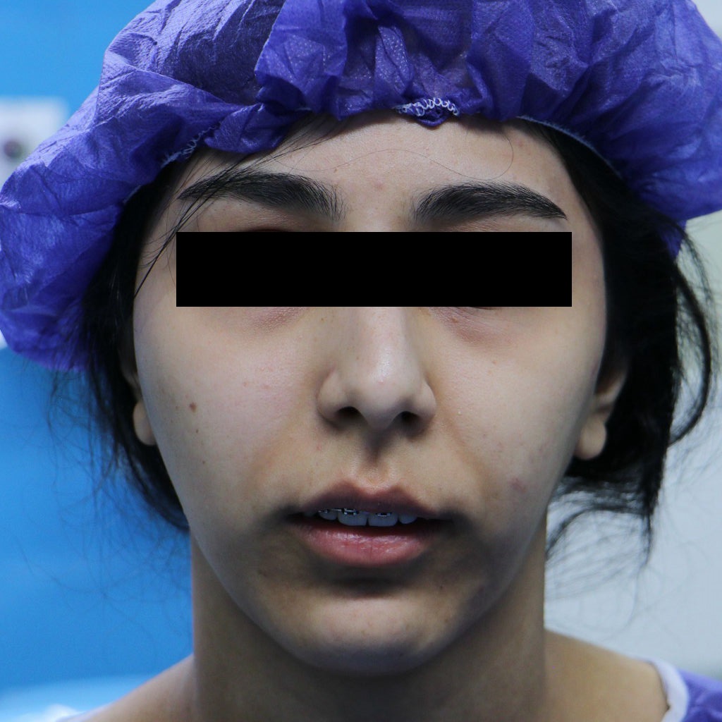 تصویر فک و مفصل فکی در صورت قبل از عمل همزمان