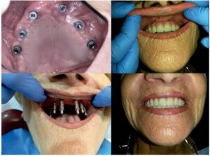 نمونه عمل پیوند ایمپلنت ساب پریوستئال