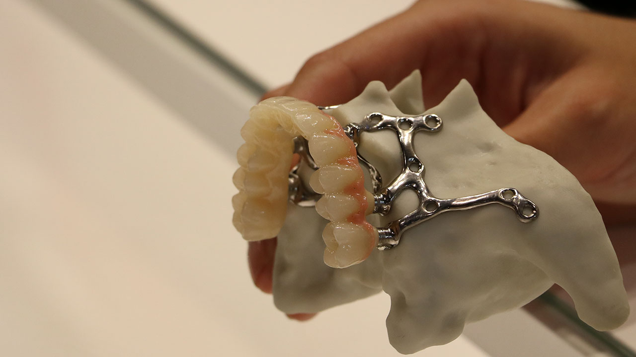 ایمپلنت ساب پریوستئال فک چیست و مناسب چه کسانی است؟