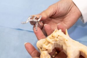 قالب گیری از فک برای ساخت ایمپلنت ساب پریوستئال فک