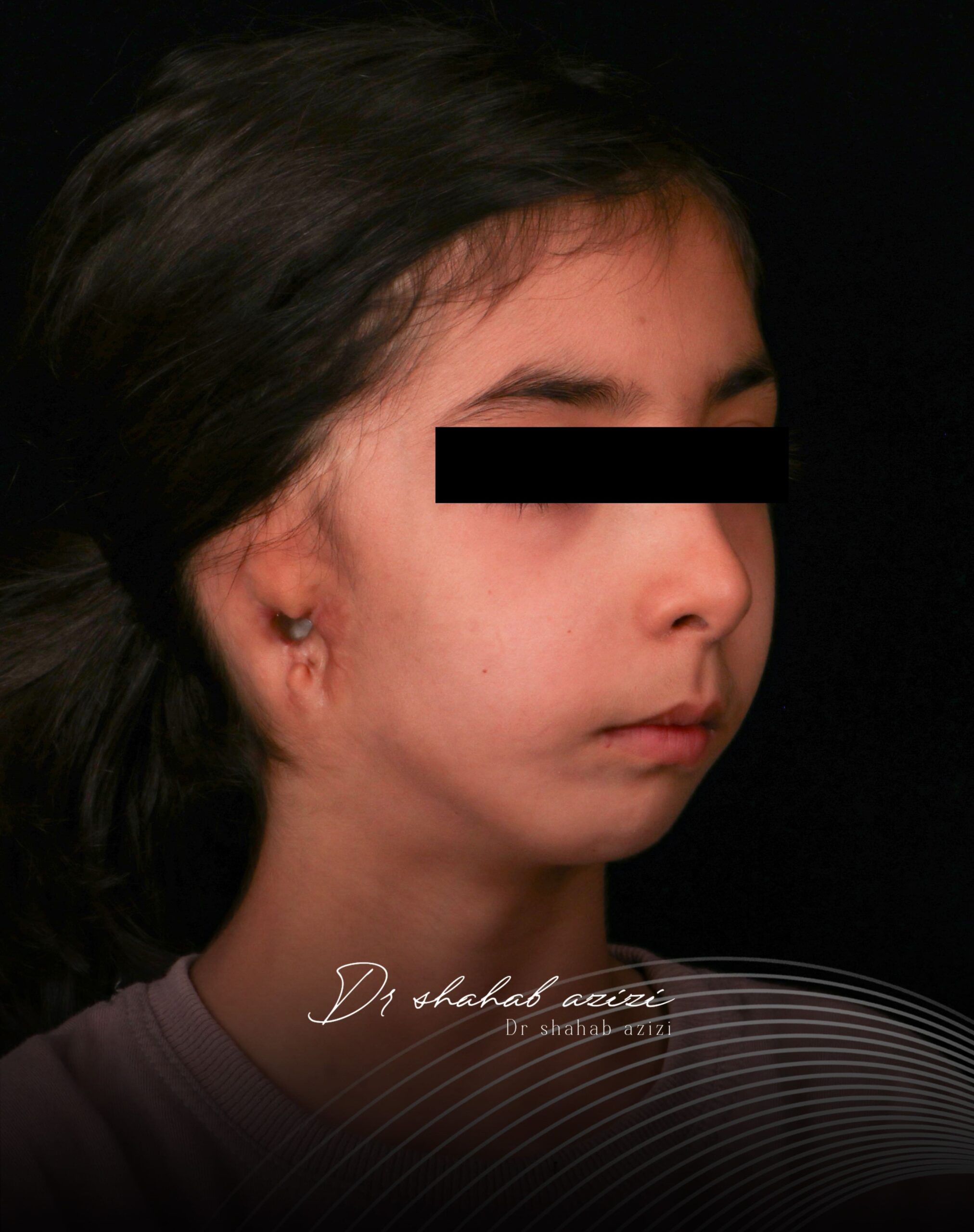 جراحی کودک دارای ناهنجاری همی فیشیال میکروزومیا توسط دکتر شهاب الدین عزیزی