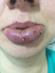 چطور سرعت بهبودی ورم بعد عمل جراحی فک را بیشتر کنیم؟