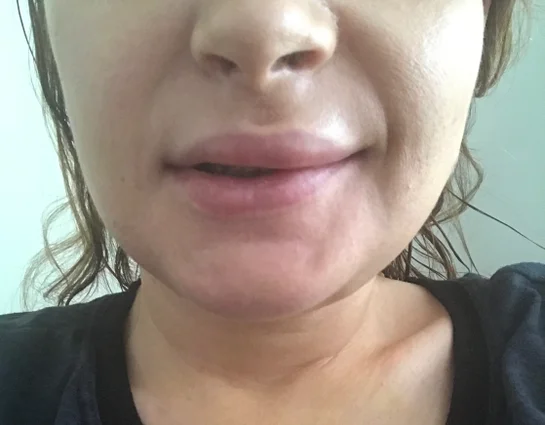 ورم لب بعد از جراحی فک چقدر طول می‌کشد تا محو شود؟