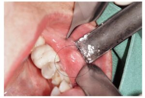 روش نمونه برداری فک و صورت کودکانی که تومور بدخیم دارند