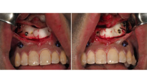 برش داخل دهانی در عمل جراحی فک