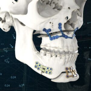 چرا از پلاک در جراحی فک استفاده می کنند؟