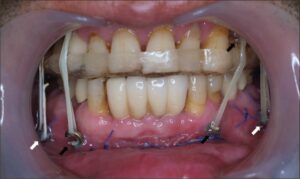 چرا در فک پیچ می‌گذارند؟ توضیحات دکتر عزیزی در مورد دلیل استفاده از پیچ در فک صورت