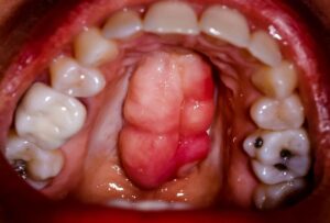 تشخیص و درمان تومور فک و دهان در کودکان