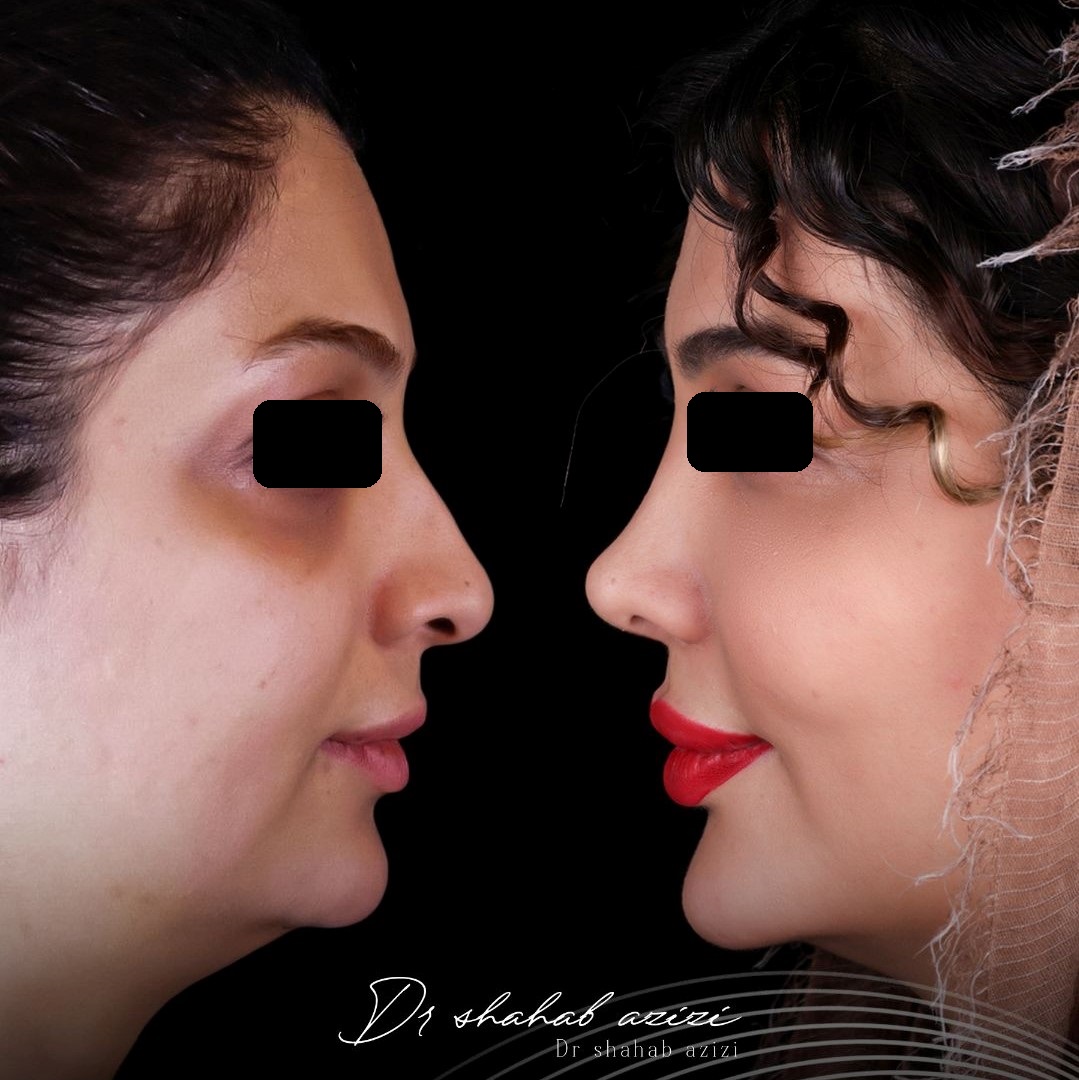 عکس قبل و بعد جراحی بینی