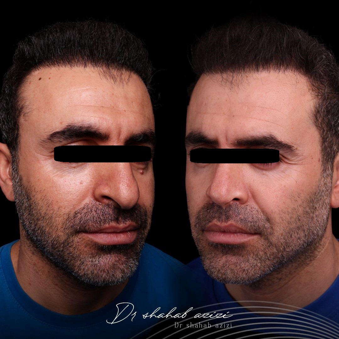 عکس قبل و بعد عمل بینی طبیعی