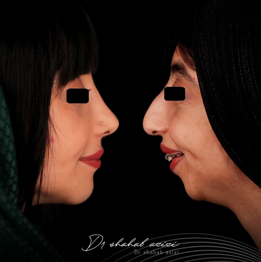 مراجعه کننده عمل بینی طبیعی