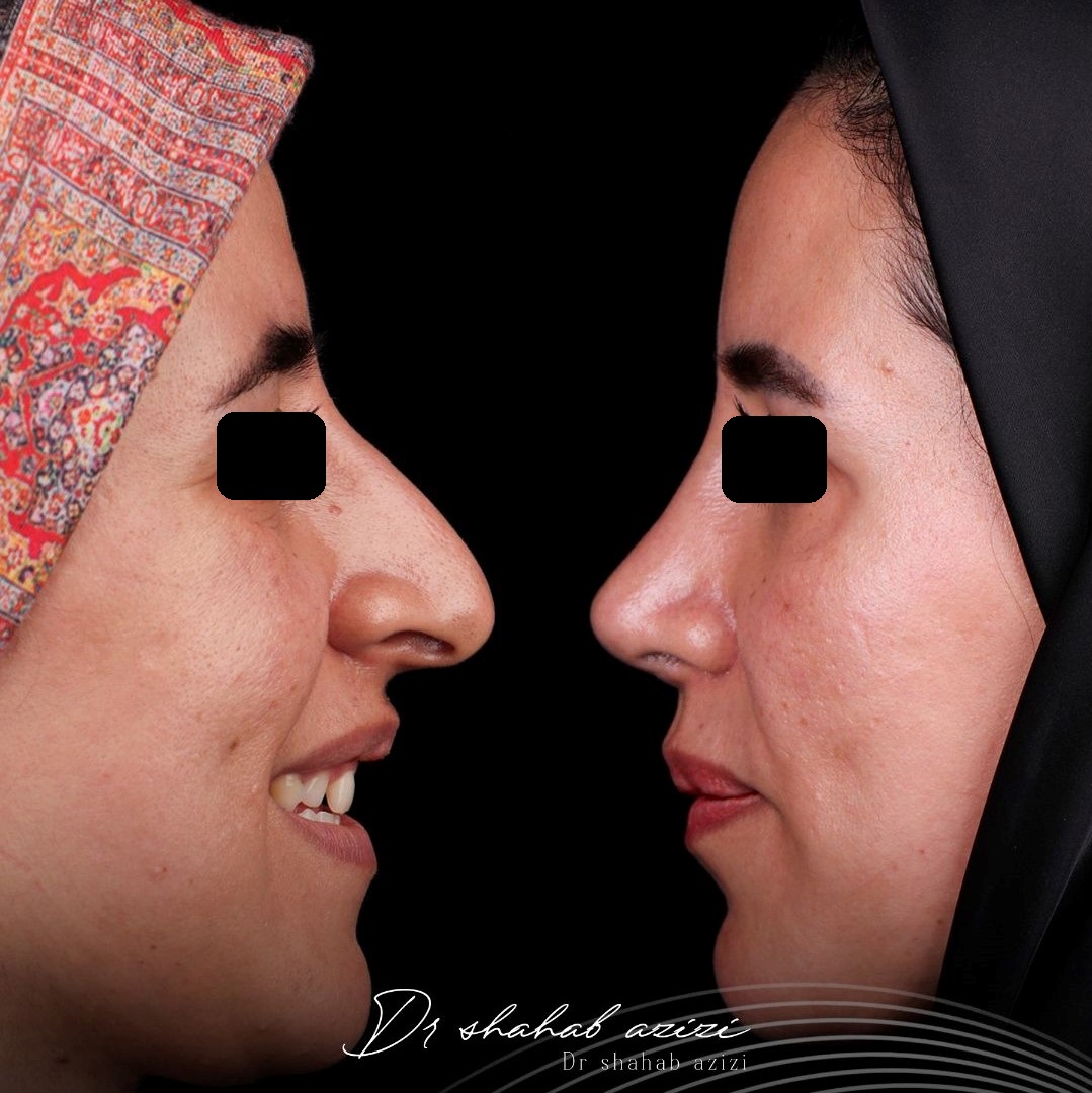 نمونه نتیجه و تصویر بعد از عمل جراحی بینی طبیعی