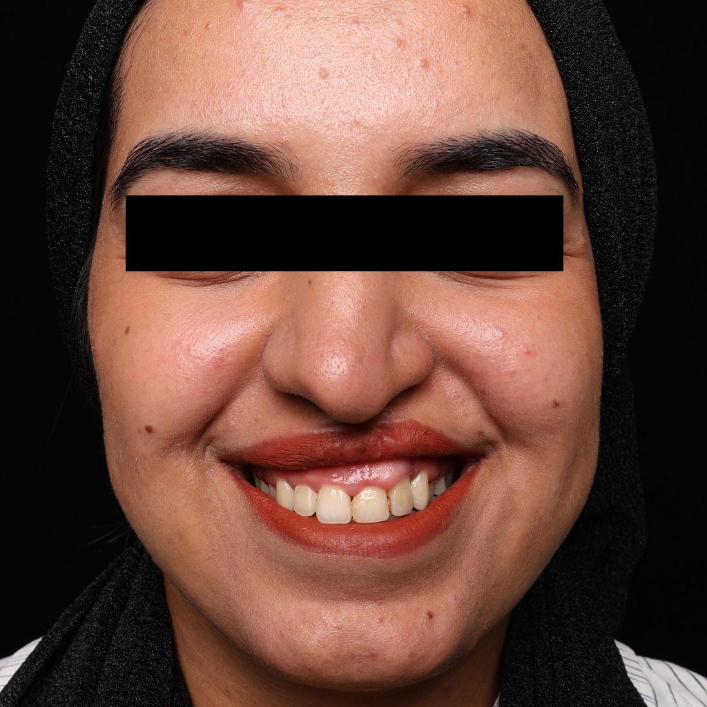 عمل پره بینی توسط دکتر شهاب الدین عزیزی در تهران