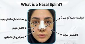 قرار گیری اسپلینت بینی بعد از عمل