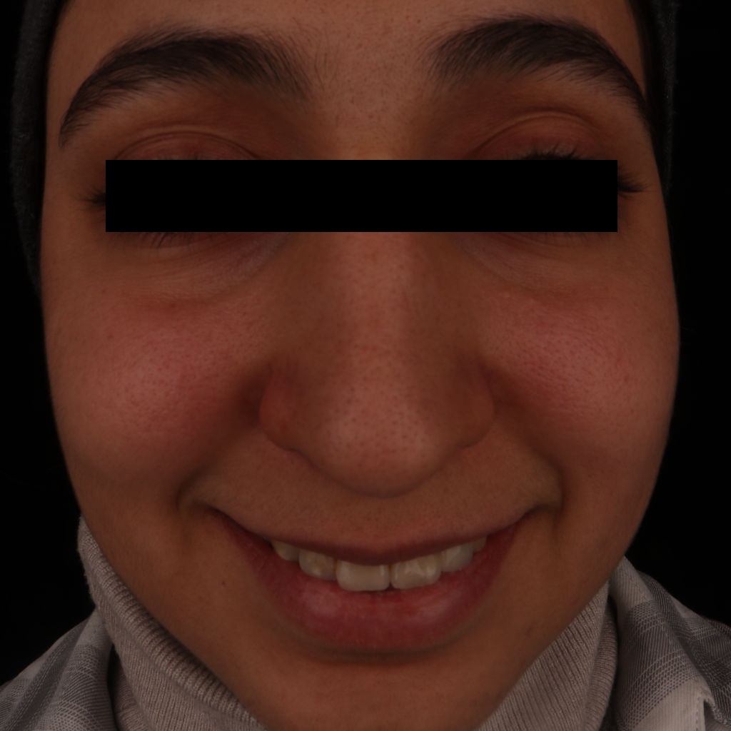 عکس قبل از عمل بینی طبیعی