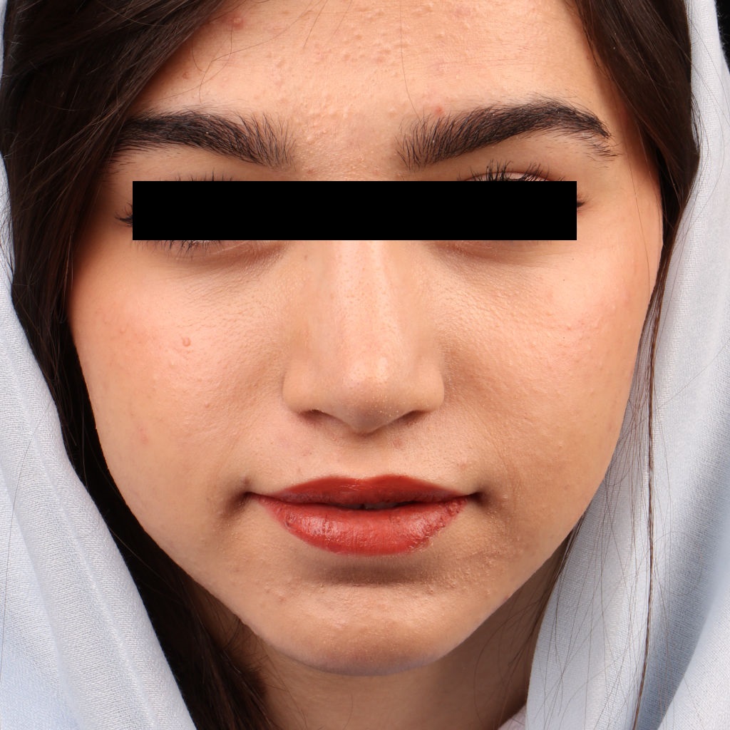 نمونه نتیجه و تصویر بعد از عمل جراحی بینی طبیعی