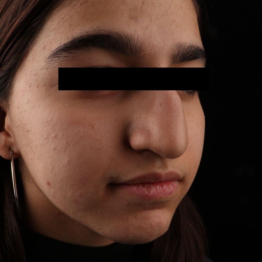 تصویر مراجعه کننده قبل از عمل طبیعی بینی