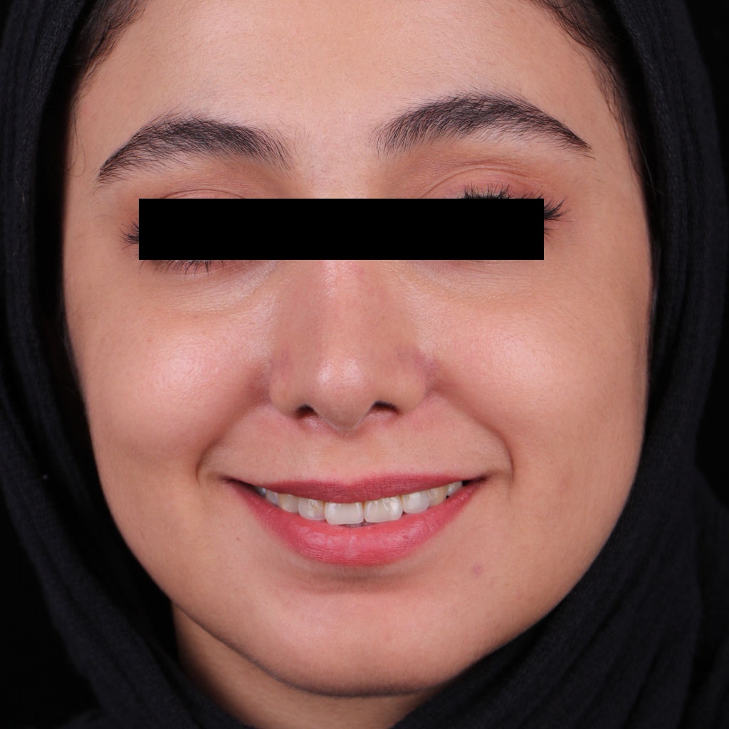 عکس بعد از جراحی بینی طبیعی