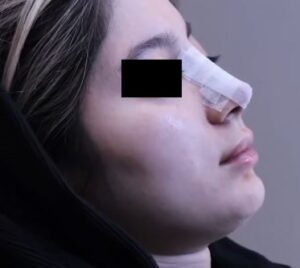 آموزش نحوه جسب زدن به بینی بعد از عمل رینوپلاستی توسط دکتر شهاب الدین عزیزی