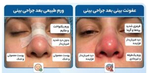 تفاوت ورم طبیعی و خطرناک بعد از عمل جراحی بینی چیست؟