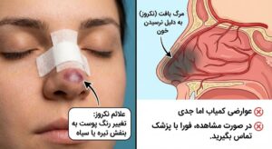 چرا داشتن علائم نکروز بعد از جراحی بینی خطرناک است؟