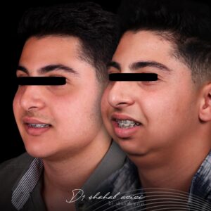 نمونه قبل و بعد عمل جراحی فک