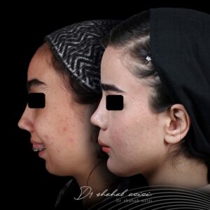 نموهه کیس جراحی فک توسط شهاب الدین عزیزی